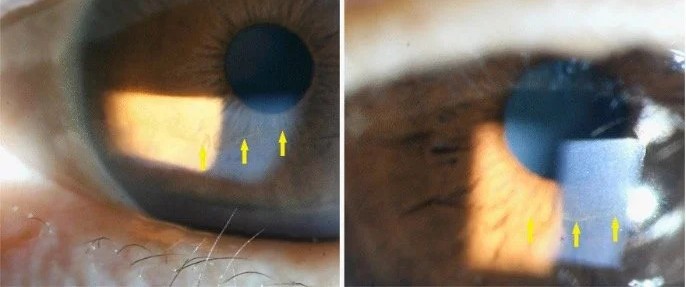 Clinical eye photograph illustrating Corneal Iron Lines Differential Diagnosis