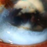 Clinical eye photograph illustrating Corneal Keloid