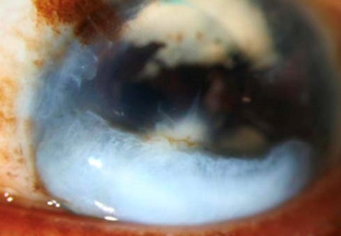 Clinical eye photograph illustrating Corneal Keloid