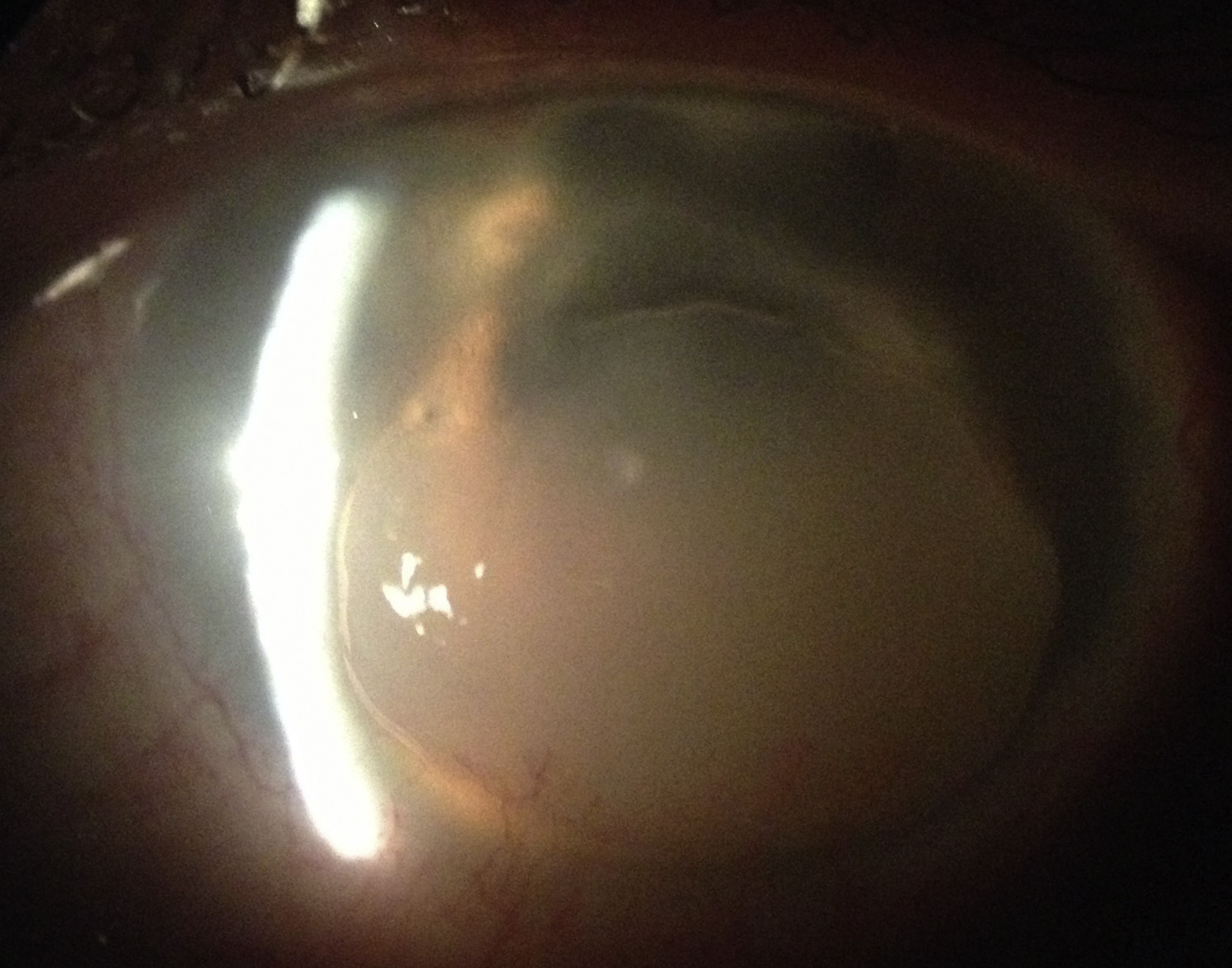 Clinical eye photograph illustrating Corneal Keloid