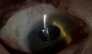 Clinical eye photograph illustrating Corneal Laceration Repair