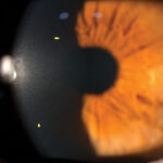 Clinical eye photograph illustrating Corneal Nerve Regeneration Imaging