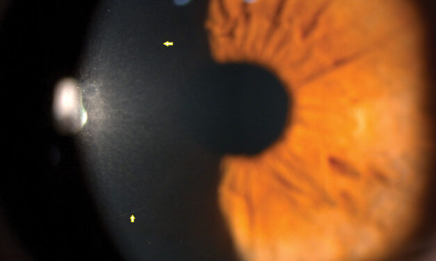 Corneal Nerve Imaging: What Confocal Microscopy Shows Before the Cornea Loses Feeling