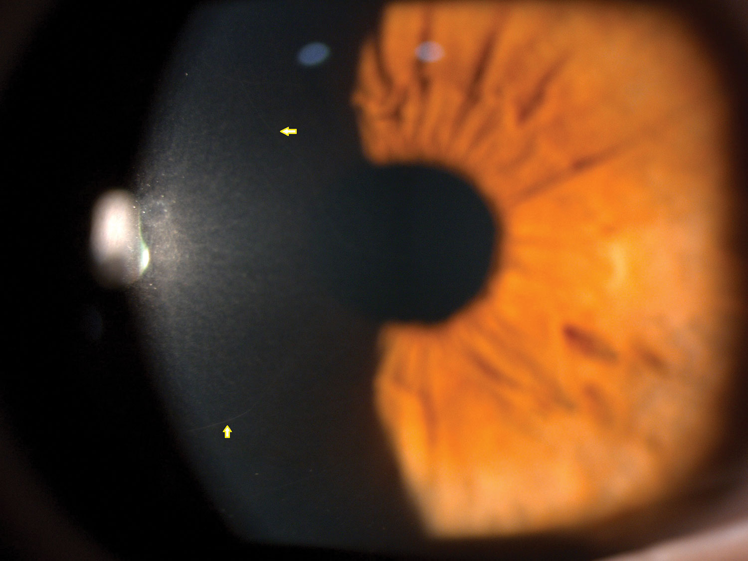 Clinical eye photograph illustrating Corneal Nerve Regeneration Imaging
