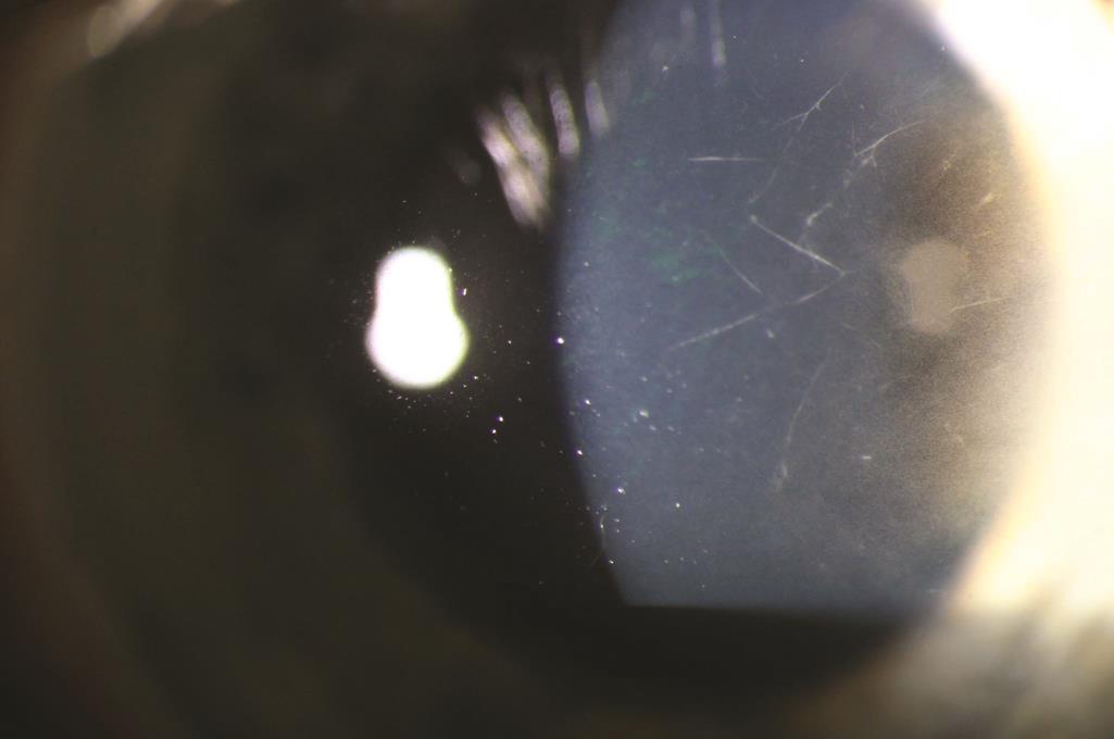 Clinical eye photograph illustrating Corneal Nerve Regeneration Imaging