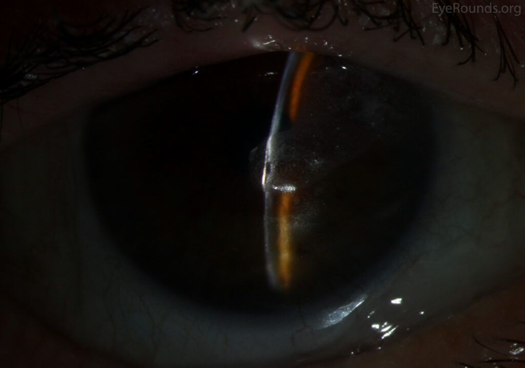Clinical eye photograph illustrating Corneal Perforation Cyanoacrylate Glue