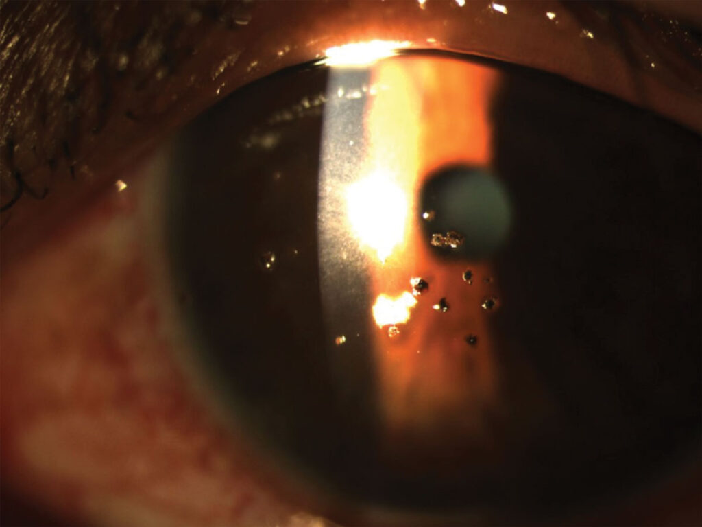 Clinical eye photograph illustrating Corneal Rust Ring Removal