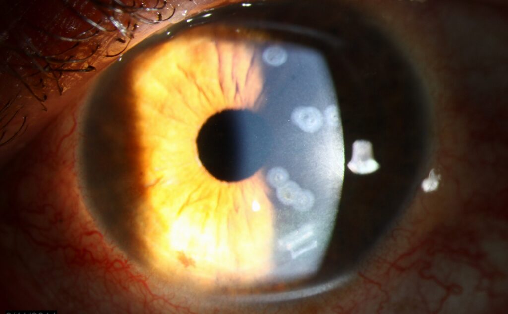 Clinical eye photograph illustrating Corneal Scar Nebula Macula Leucoma