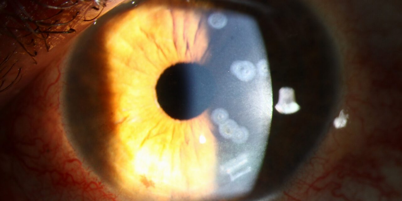 Corneal Scar Types: Nebula, Macula, Leucoma and Adherent Leucoma Explained
