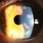 Clinical eye photograph illustrating Corneal Scar Nebula Macula Leucoma