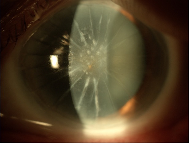 Clinical eye photograph illustrating Corneal Scar Nebula Macula Leucoma