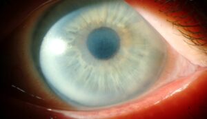 Clinical image illustrating Corneal Sensation (Cotton Wisp Test)