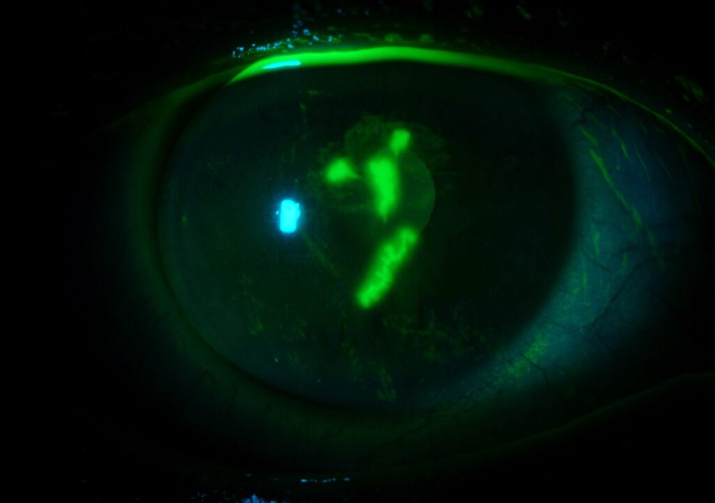 Clinical eye photograph illustrating Corneal Staining Patterns Diagnosis