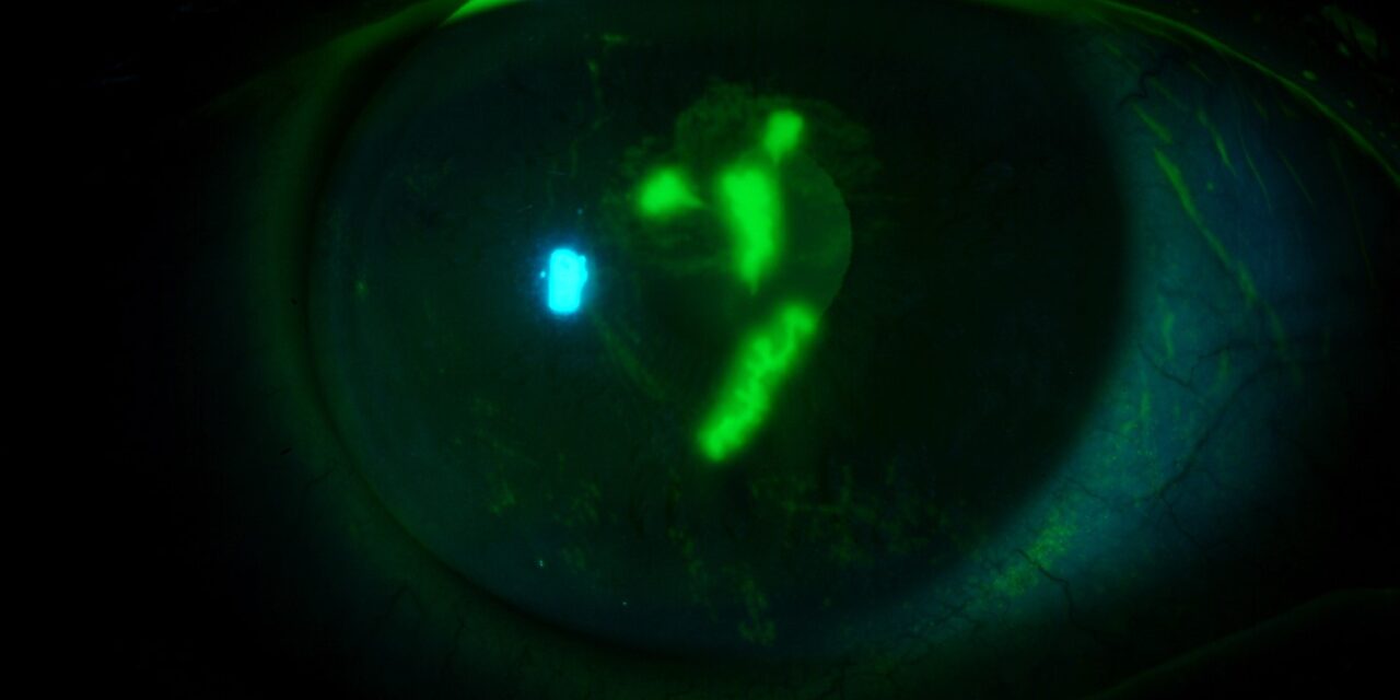 Corneal Staining Patterns: What the Location of Fluorescein and Lissamine Green Staining Tells You