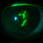 Clinical eye photograph illustrating Corneal Staining Patterns Diagnosis