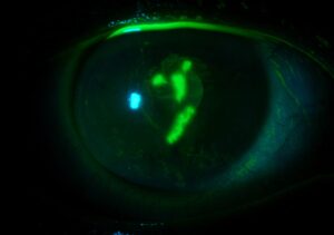 Clinical eye photograph illustrating Corneal Staining Patterns Diagnosis