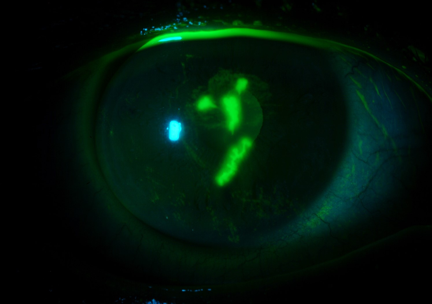 Clinical eye photograph illustrating Corneal Staining Patterns Diagnosis