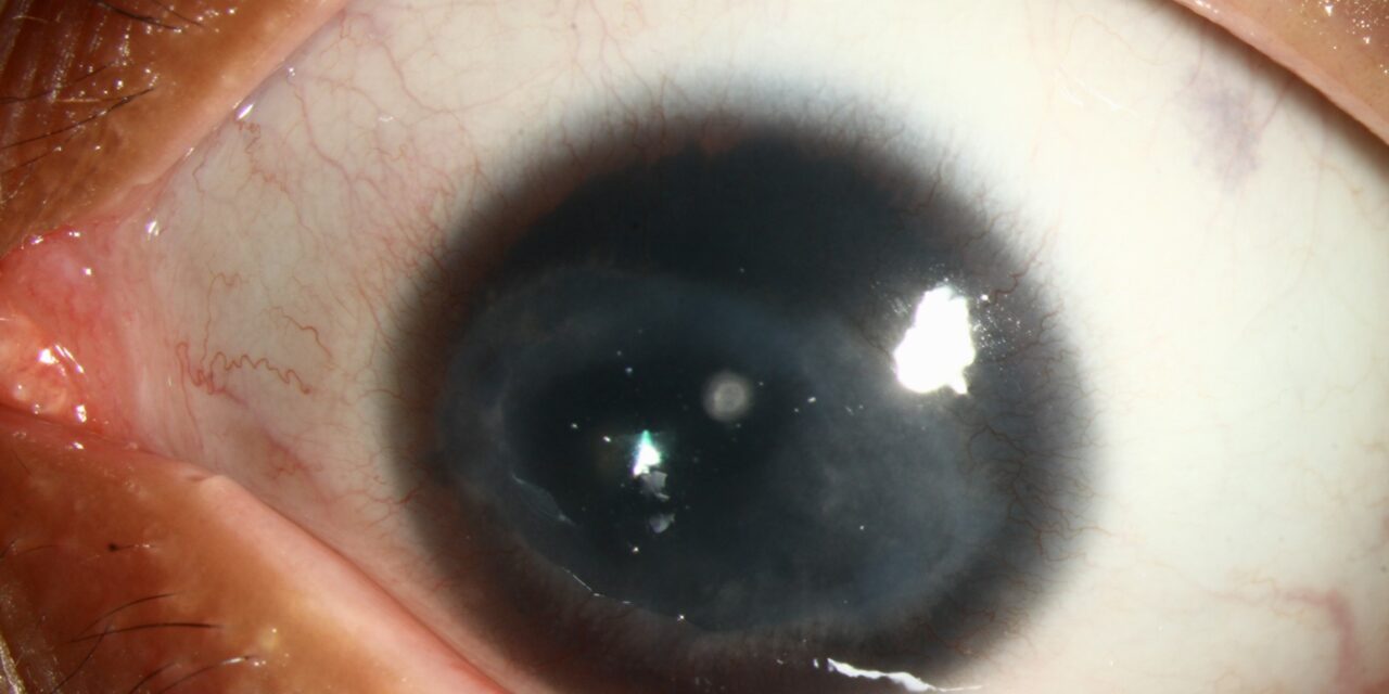 Corneal Vascularization and Pannus: Reading a Cornea That Has Recruited Its Own Blood Supply