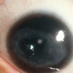 Clinical eye photograph illustrating Corneal Vascularization Pannus Causes
