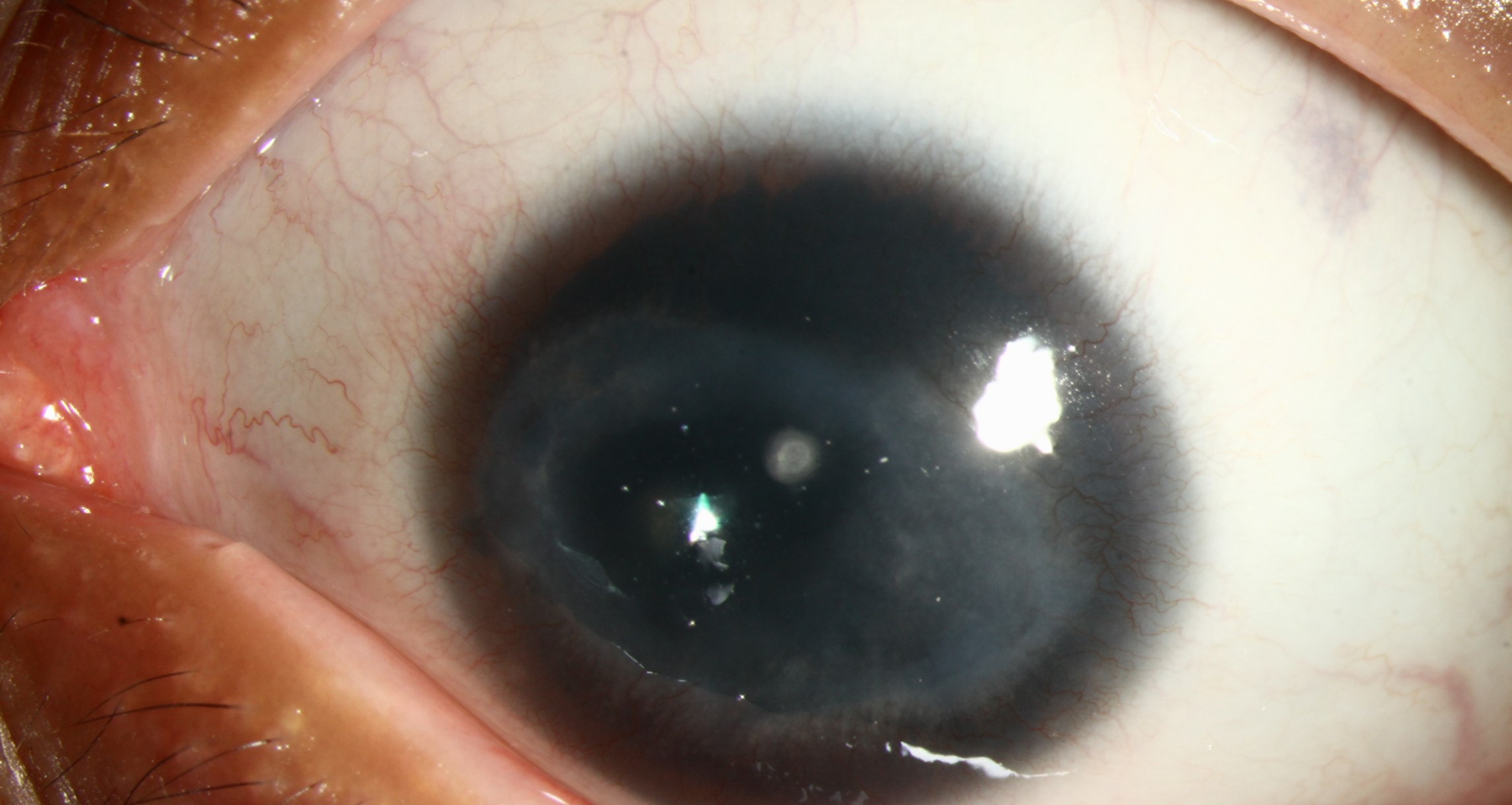 Clinical eye photograph illustrating Corneal Vascularization Pannus Causes