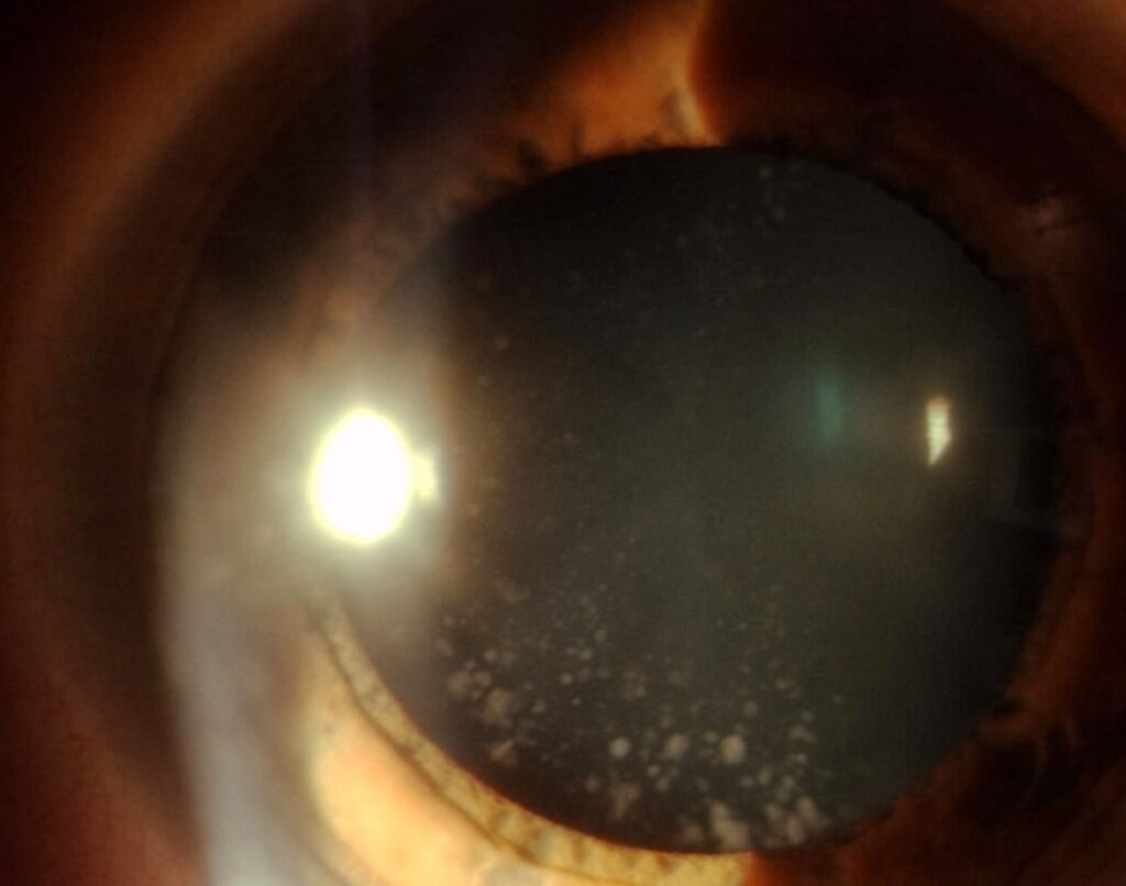 Clinical eye photograph illustrating Coronary Cataract