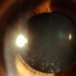 Clinical eye photograph illustrating Coronary Cataract