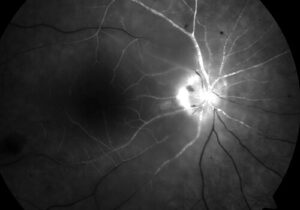 Clinical image illustrating CRAO vs CRVO (figure 1)