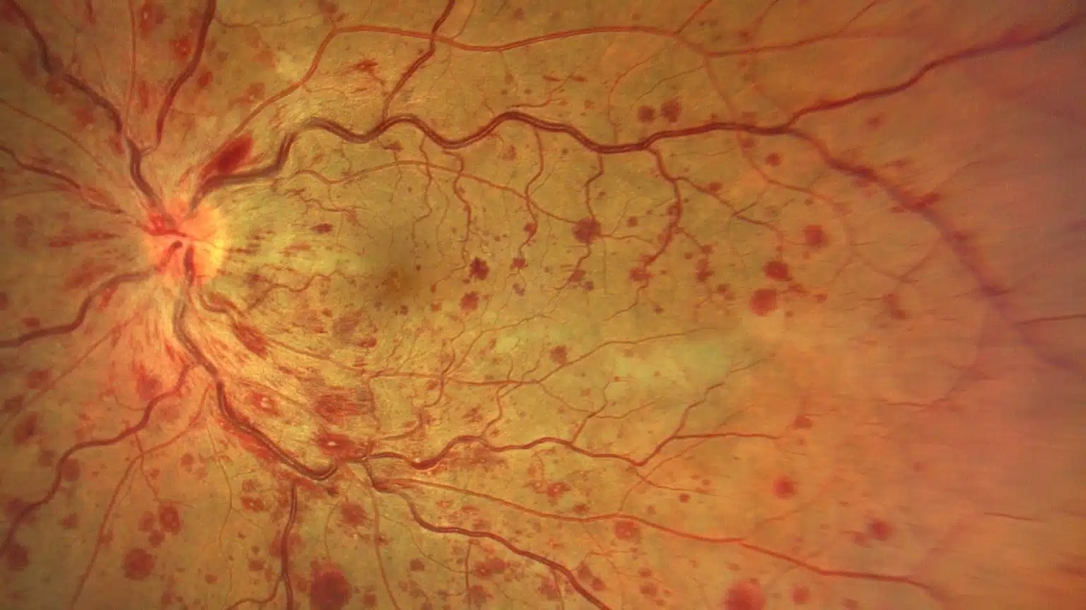 Clinical image illustrating CRAO vs CRVO (figure 2)