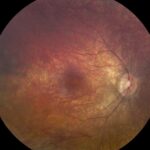 Clinical eye photograph illustrating Crispr Gene Editing Eye