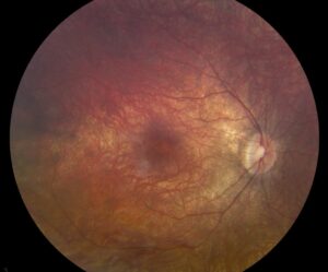 Clinical eye photograph illustrating Crispr Gene Editing Eye
