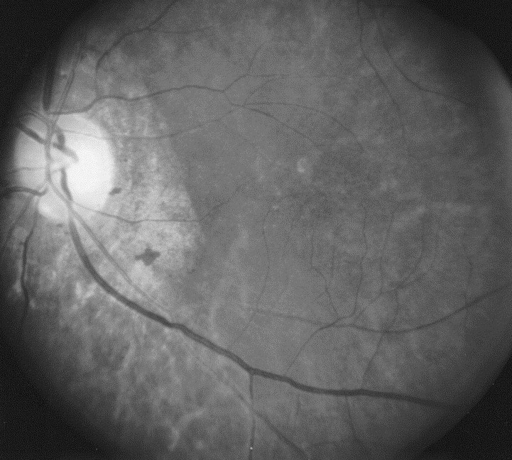 Clinical eye photograph illustrating Crispr Gene Editing Eye