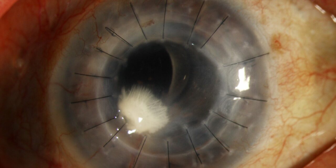 Crystalline Keratopathy: When Deposits in the Cornea Point to an Indolent Infection