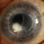Clinical eye photograph illustrating Crystalline Keratopathy Infectious Causes