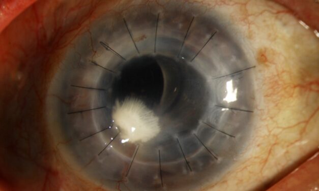 Crystalline Keratopathy: When Deposits in the Cornea Point to an Indolent Infection
