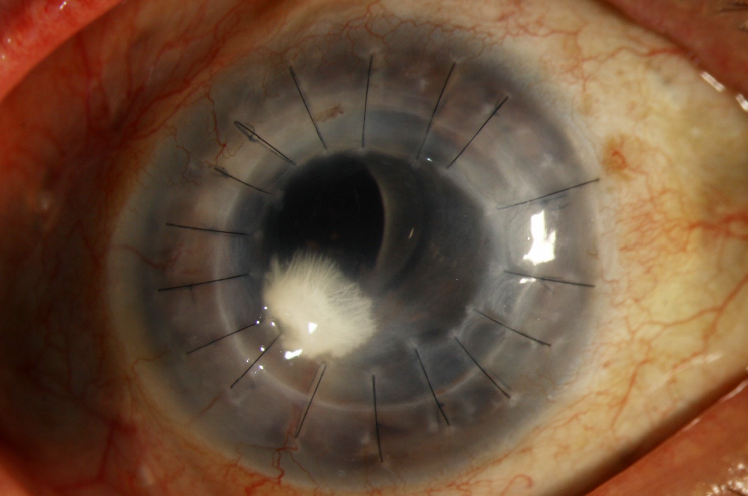 Clinical eye photograph illustrating Crystalline Keratopathy Infectious Causes