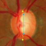 Clinical eye photograph illustrating Cup to Disc Ratio Assessment Pitfalls
