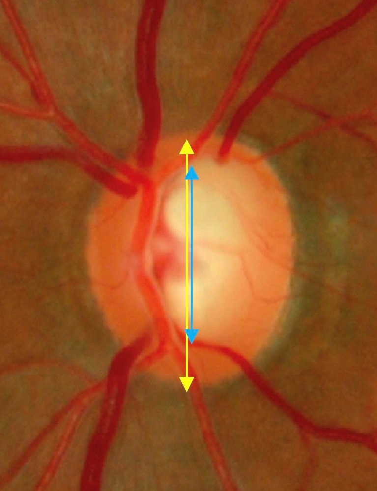 Clinical eye photograph illustrating Cup to Disc Ratio Assessment Pitfalls