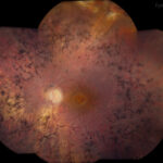 Clinical eye photograph illustrating Cystoid Macular Edema Retinitis Pigmentosa