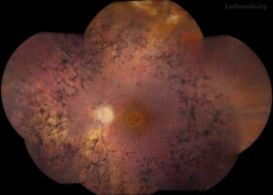 Clinical eye photograph illustrating Cystoid Macular Edema Retinitis Pigmentosa