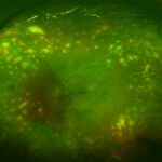 Clinical eye photograph illustrating Dalen Fuchs Nodules Granulomatous Uveitis