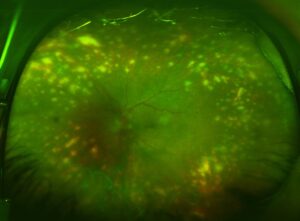 Clinical eye photograph illustrating Dalen Fuchs Nodules Granulomatous Uveitis