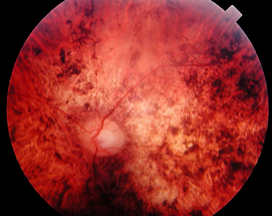 Clinical eye photograph illustrating Dark Adaptation Testing