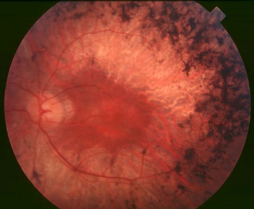 Clinical eye photograph illustrating Dark Adaptation Testing