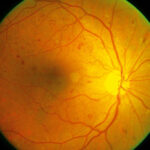 Clinical eye photograph illustrating Dcct Edic Retinopathy