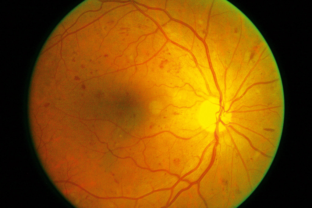 Clinical eye photograph illustrating Dcct Edic Retinopathy