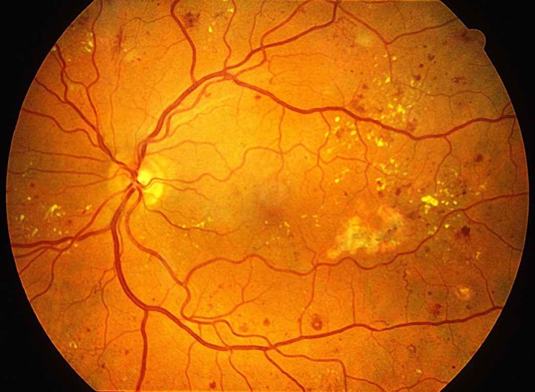 Clinical eye photograph illustrating Dcct Edic Retinopathy