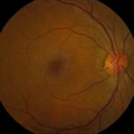 Clinical eye photograph illustrating Deferoxamine Retinopathy
