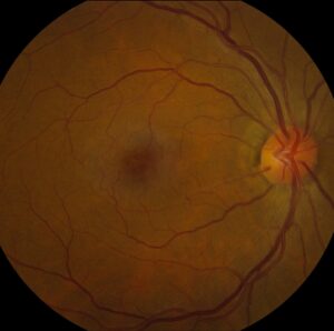 Clinical eye photograph illustrating Deferoxamine Retinopathy