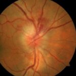 Clinical eye photograph illustrating Dermolipoma Limbal Conjunctival Mass