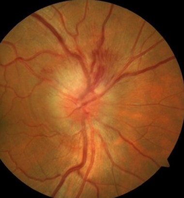 Clinical eye photograph illustrating Dermolipoma Limbal Conjunctival Mass